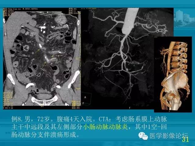 【PPT】小肠炎症性病变CT诊断