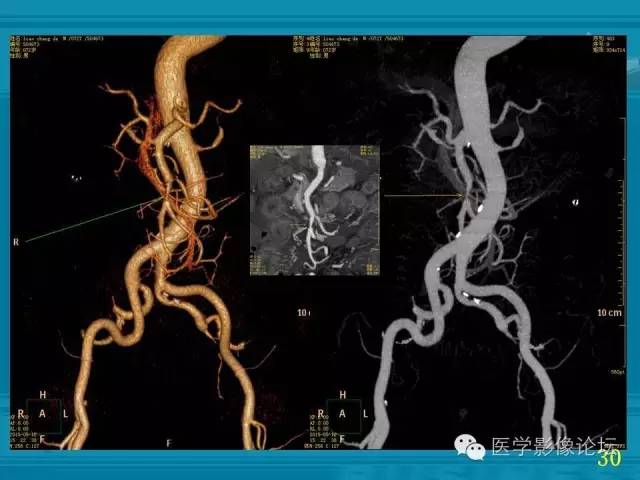 【PPT】小肠炎症性病变CT诊断