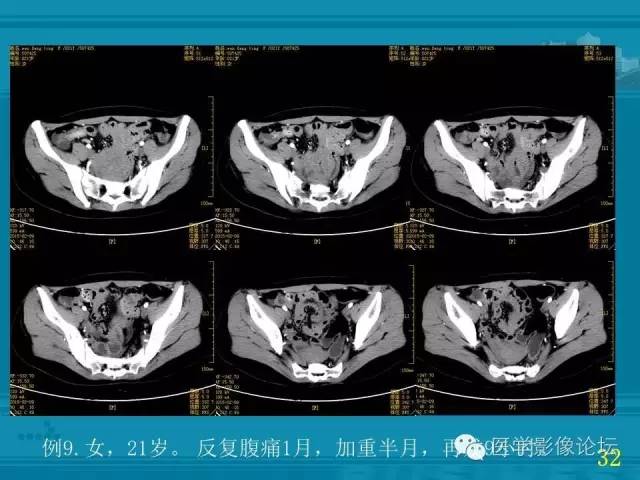 【PPT】小肠炎症性病变CT诊断