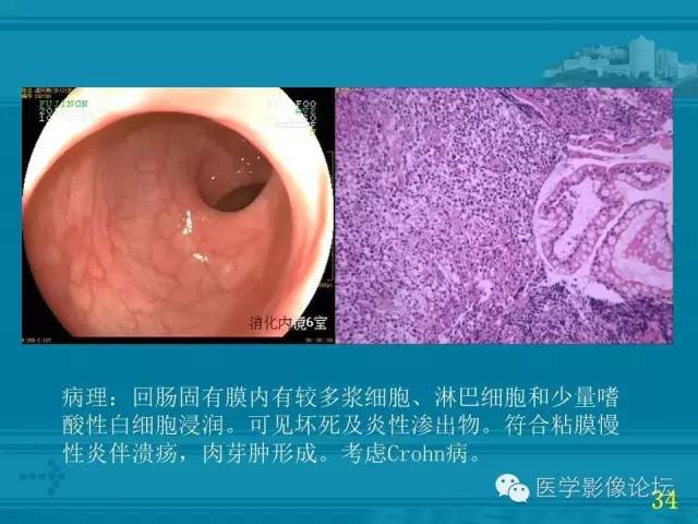 【PPT】小肠炎症性病变CT诊断