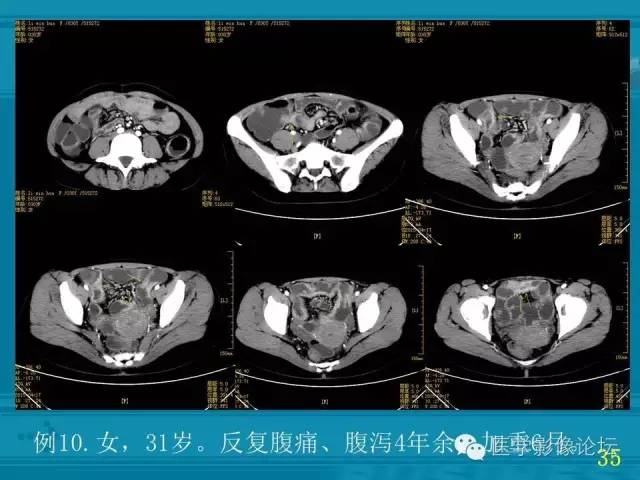 【PPT】小肠炎症性病变CT诊断