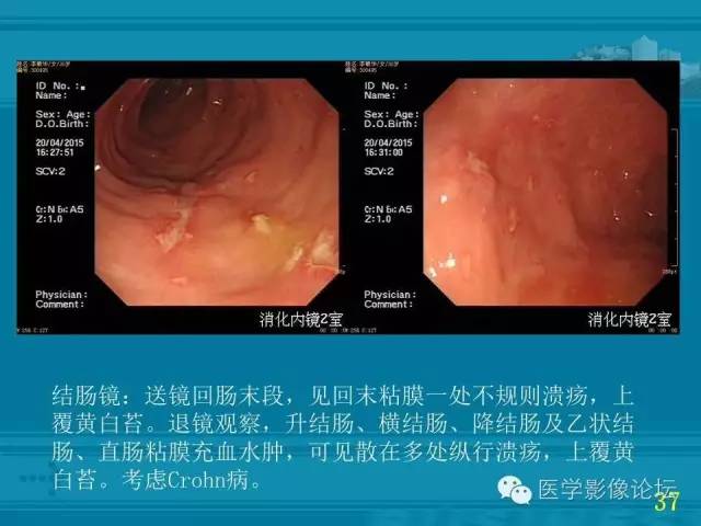 【PPT】小肠炎症性病变CT诊断