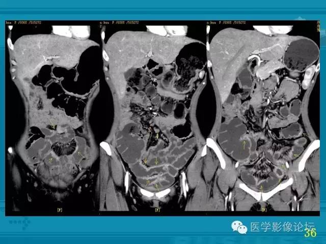 【PPT】小肠炎症性病变CT诊断