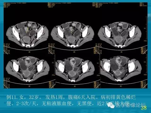 【PPT】小肠炎症性病变CT诊断