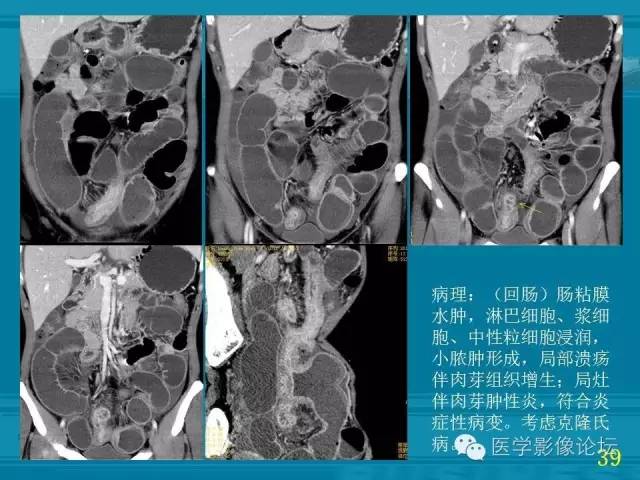 【PPT】小肠炎症性病变CT诊断