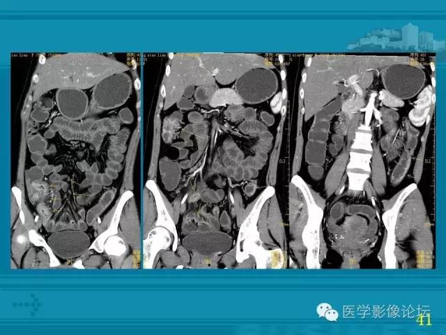 【PPT】小肠炎症性病变CT诊断