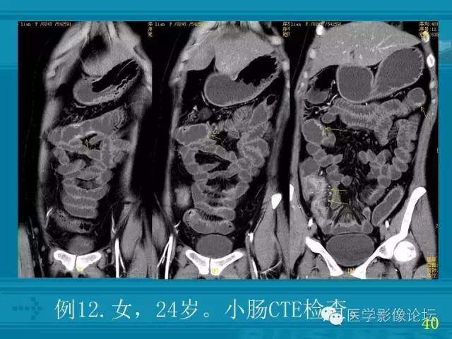【PPT】小肠炎症性病变CT诊断