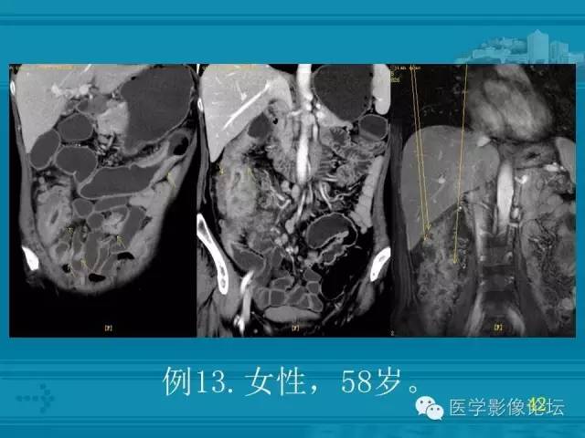 【PPT】小肠炎症性病变CT诊断