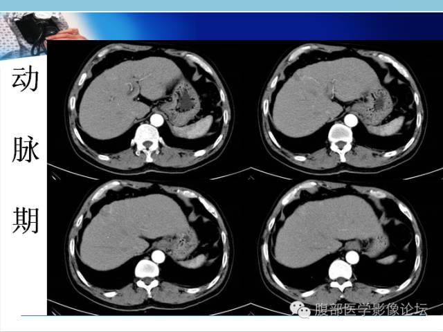 【病例】混合型肝癌1例CT影像征象分析 【病例】混合型肝癌1例CT影像征象分析