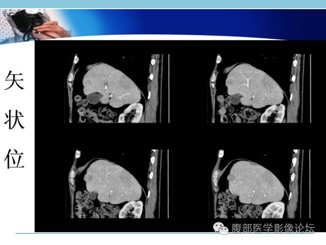 【病例】混合型肝癌1例CT影像征象分析 【病例】混合型肝癌1例CT影像征象分析