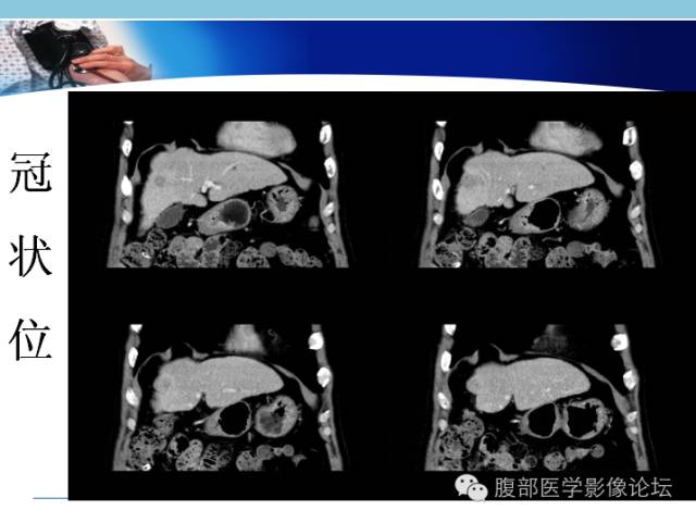 【病例】混合型肝癌1例CT影像征象分析 【病例】混合型肝癌1例CT影像征象分析