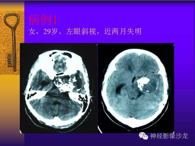 【病例】鞍旁肿瘤三例CT及MR影像表现