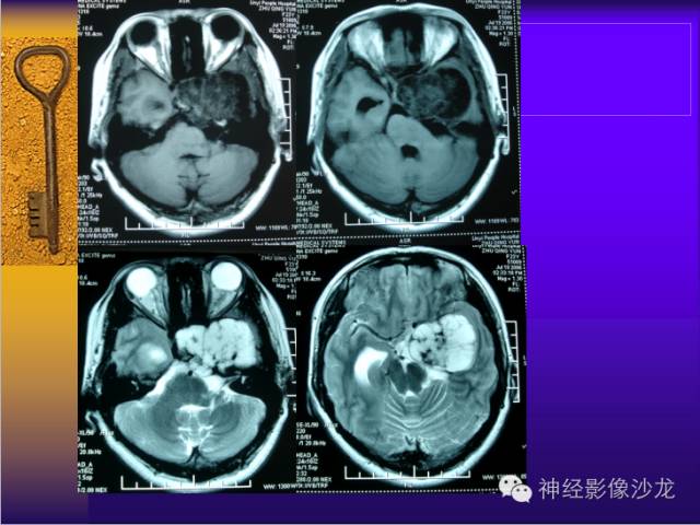 【病例】鞍旁肿瘤三例CT及MR影像表现