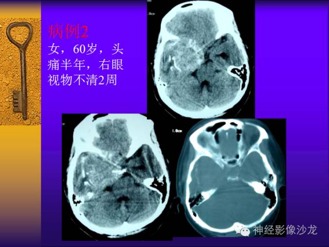 【病例】鞍旁肿瘤三例CT及MR影像表现