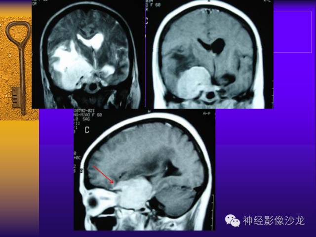 【病例】鞍旁肿瘤三例CT及MR影像表现