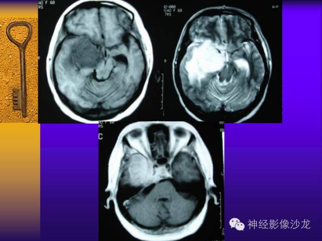 【病例】鞍旁肿瘤三例CT及MR影像表现