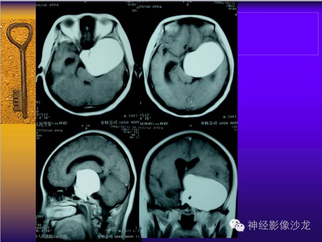 【病例】鞍旁肿瘤三例CT及MR影像表现