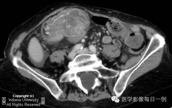 【病例】结肠套叠1例CT及X线影像表现 【病例】结肠套叠1例CT及X线影像表现