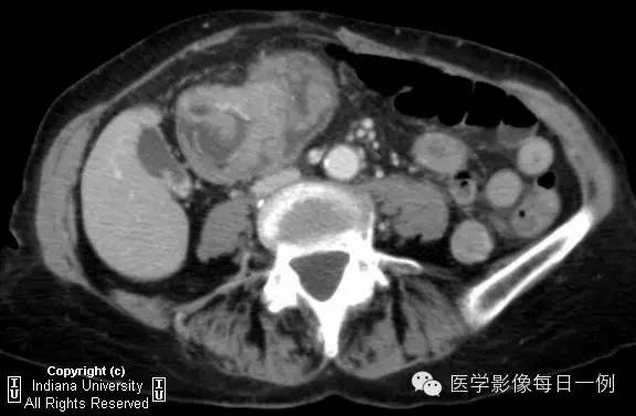 【病例】结肠套叠1例CT及X线影像表现