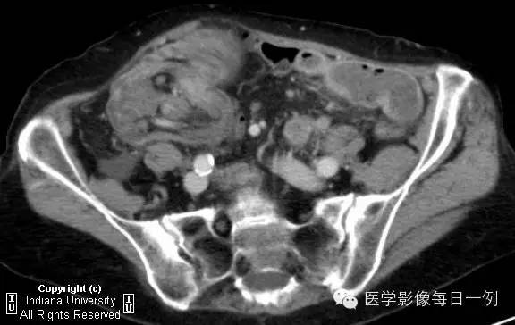 【病例】结肠套叠1例CT及X线影像表现 【病例】结肠套叠1例CT及X线影像表现