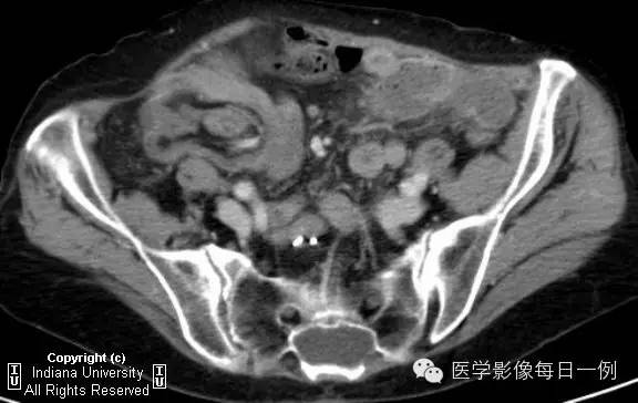 【病例】结肠套叠1例CT及X线影像表现 【病例】结肠套叠1例CT及X线影像表现