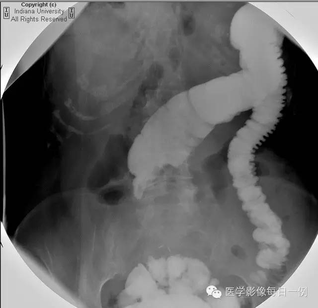 【病例】结肠套叠1例CT及X线影像表现 【病例】结肠套叠1例CT及X线影像表现