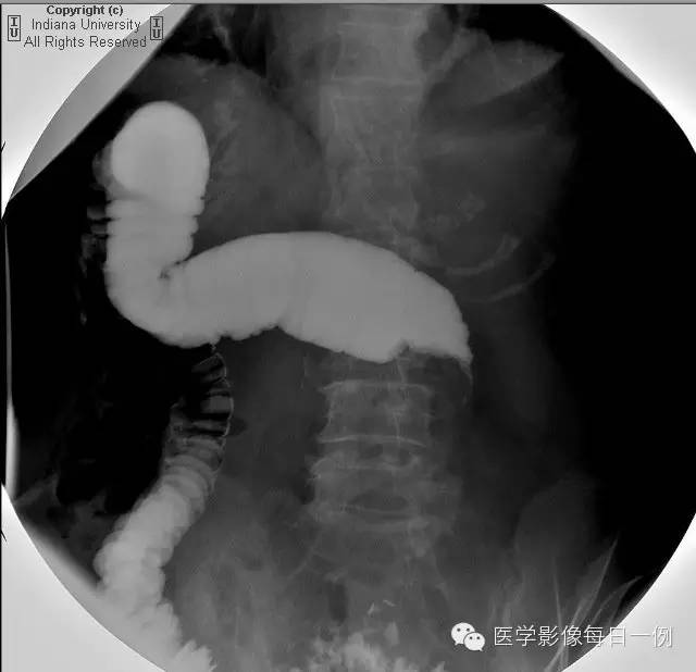 【病例】结肠套叠1例CT及X线影像表现 【病例】结肠套叠1例CT及X线影像表现