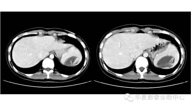 【病例】脾脏囊性占位——寄生虫1例CT影像表现