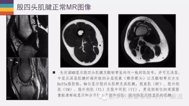 【PPT】膝关节周围肌腱解剖及MR表现