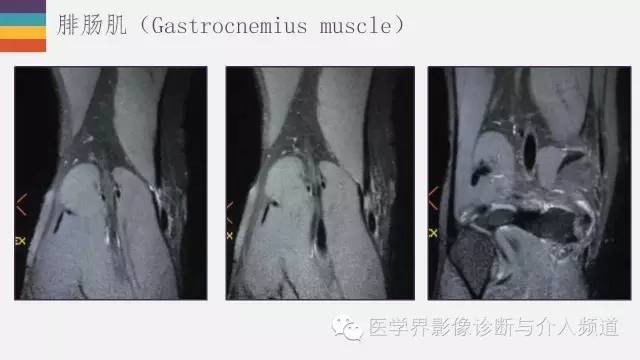 【PPT】膝关节周围肌腱解剖及MR表现