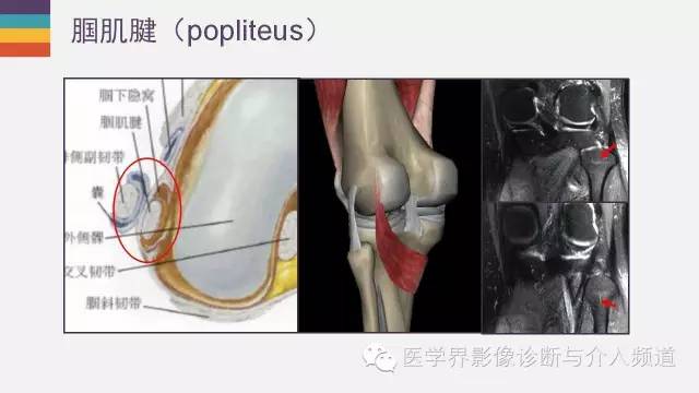 【PPT】膝关节周围肌腱解剖及MR表现