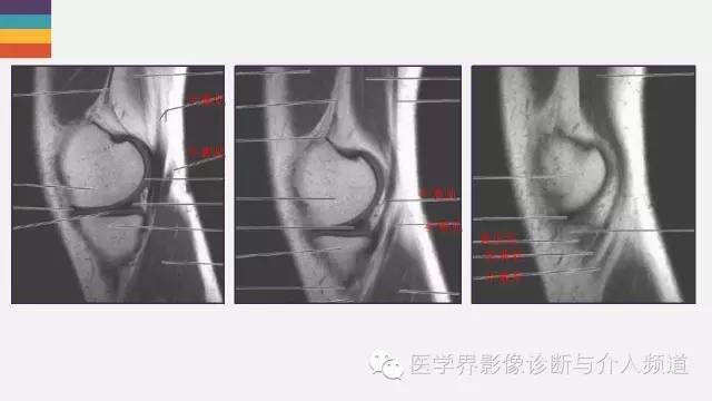 【PPT】膝关节周围肌腱解剖及MR表现