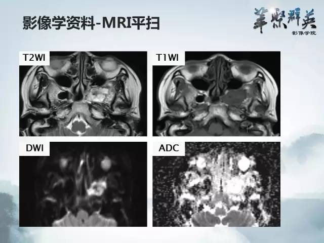 【病例】蝶骨软骨粘液样纤维瘤1例CT及MR影像表现