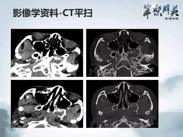 【病例】蝶骨软骨粘液样纤维瘤1例CT及MR影像表现