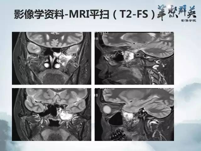 【病例】蝶骨软骨粘液样纤维瘤1例CT及MR影像表现