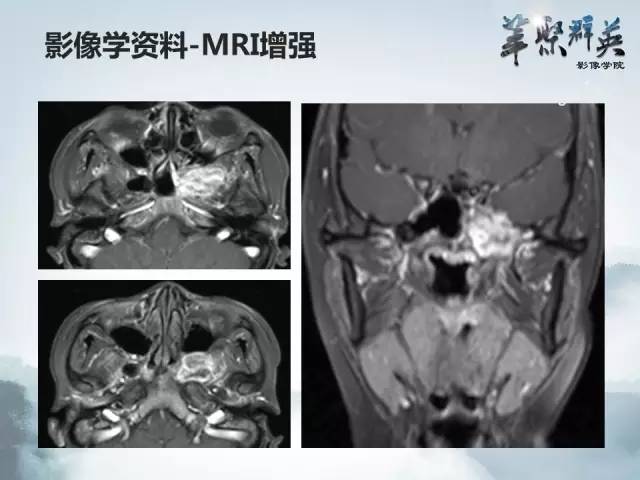 【病例】蝶骨软骨粘液样纤维瘤1例CT及MR影像表现