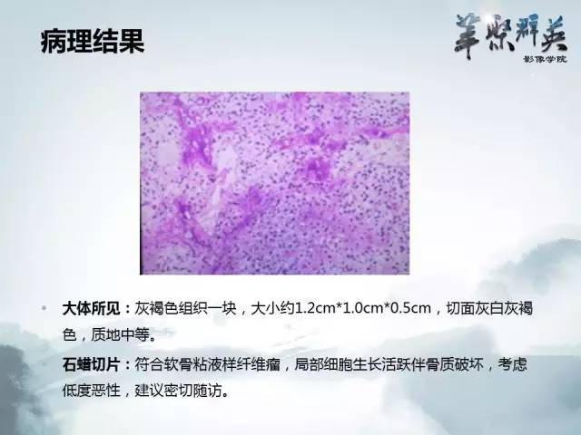 【病例】蝶骨软骨粘液样纤维瘤1例CT及MR影像表现