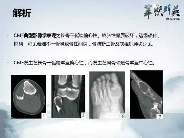 【病例】蝶骨软骨粘液样纤维瘤1例CT及MR影像表现