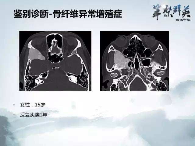 【病例】蝶骨软骨粘液样纤维瘤1例CT及MR影像表现