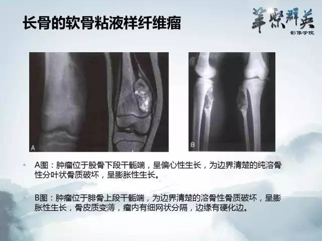 【病例】蝶骨软骨粘液样纤维瘤1例CT及MR影像表现