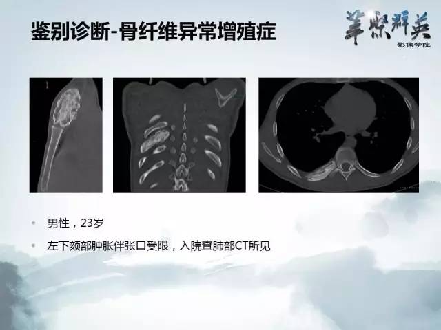 【病例】蝶骨软骨粘液样纤维瘤1例CT及MR影像表现