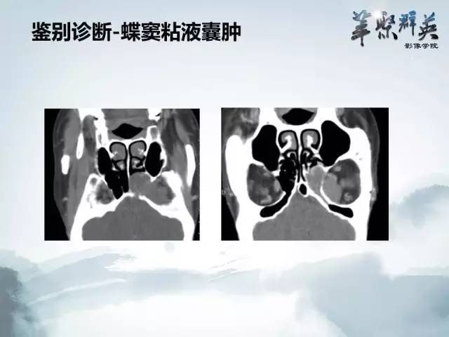 【病例】蝶骨软骨粘液样纤维瘤1例CT及MR影像表现