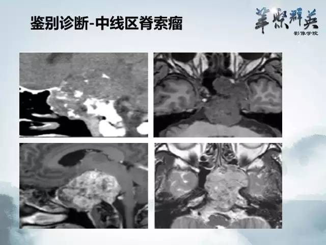 【病例】蝶骨软骨粘液样纤维瘤1例CT及MR影像表现