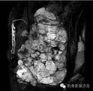 【病例】骶尾部占位4例影像鉴别诊断 【病例】骶尾部占位4例影像鉴别诊断
