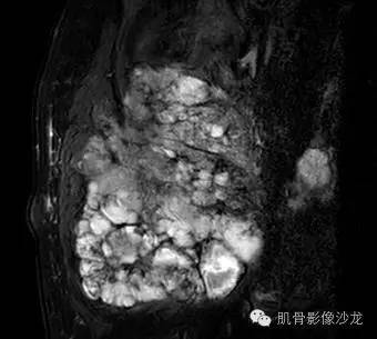 【病例】骶尾部占位4例影像鉴别诊断 【病例】骶尾部占位4例影像鉴别诊断