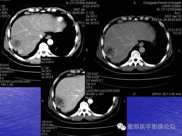 【PPT】肝内胆管细胞癌影像学诊断 【PPT】肝内胆管细胞癌影像学诊断