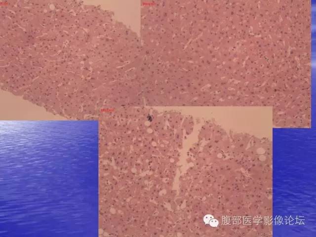【PPT】肝内胆管细胞癌影像学诊断 【PPT】肝内胆管细胞癌影像学诊断