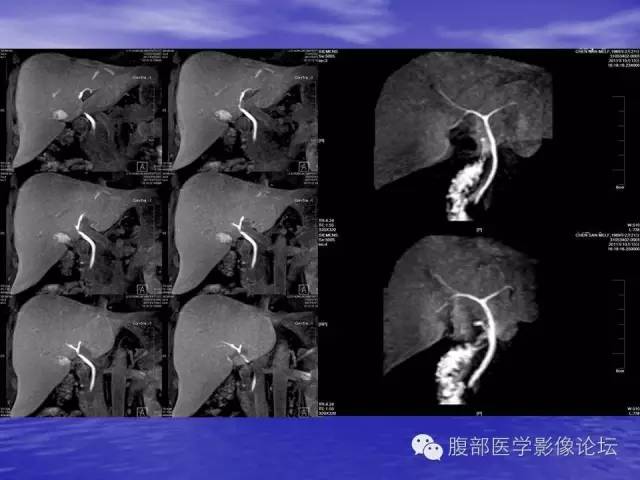 【PPT】肝内胆管细胞癌影像学诊断 【PPT】肝内胆管细胞癌影像学诊断