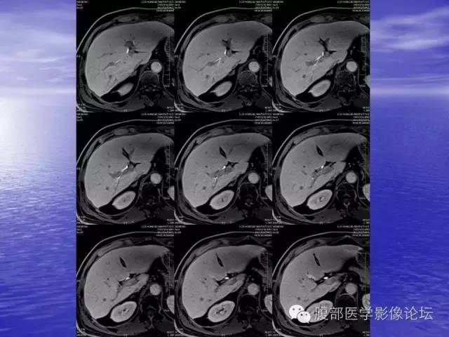 【PPT】肝内胆管细胞癌影像学诊断 【PPT】肝内胆管细胞癌影像学诊断