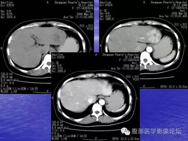 【PPT】肝内胆管细胞癌影像学诊断 【PPT】肝内胆管细胞癌影像学诊断